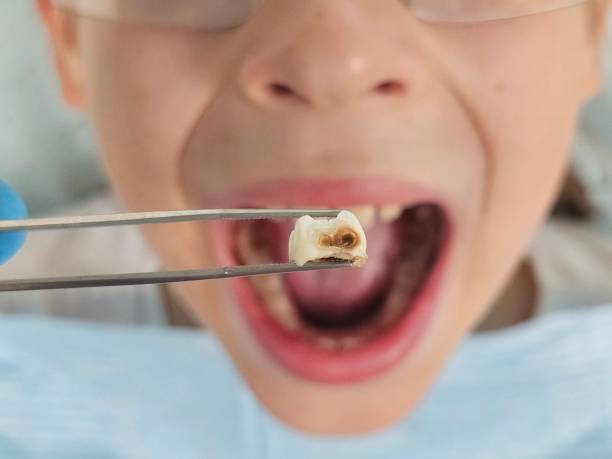 Best Broken or Cracked Tooth Emergency Dentist in Chester, CA